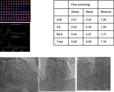 Improved detection of coronary artery disease by CZT regional coronary blood flow evaluation